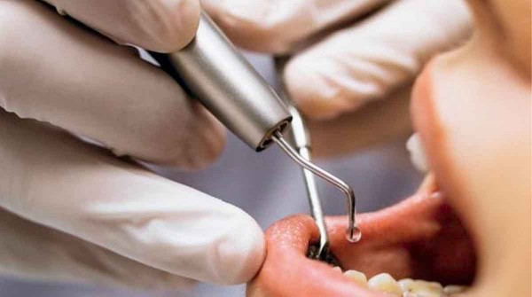 Se acab el torno y el dolor: novedosa investigacin de la UBA para el tratamiento de las caries